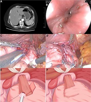 Anastomotic stenosis following proximal gastrectomy with single flap valvulopasty successfully managed with endoscopic stricturotomy: a case report